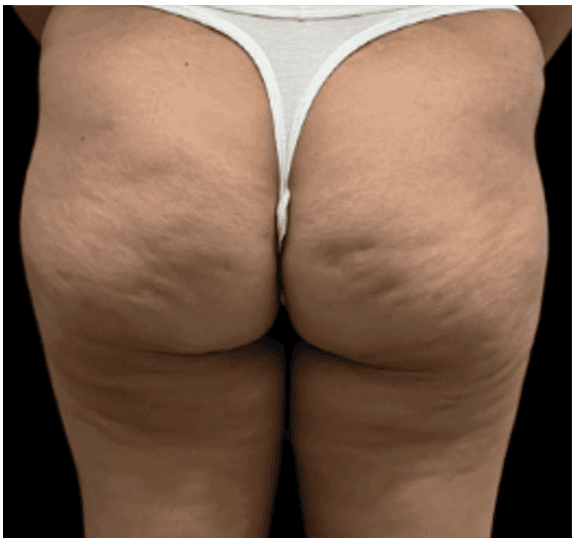 Antes - Celulite