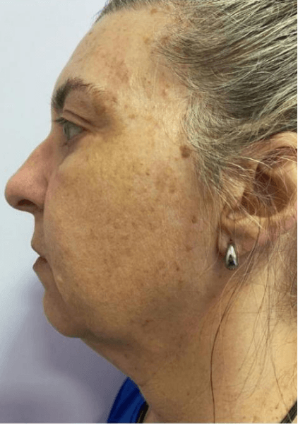 Antes - Perfilamento Facial