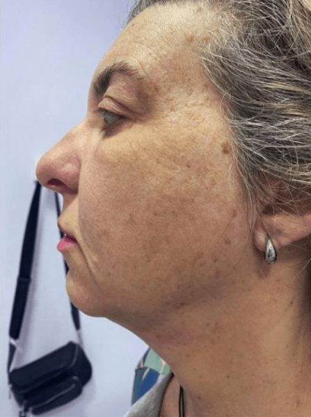 Depois - Perfilamento Facial