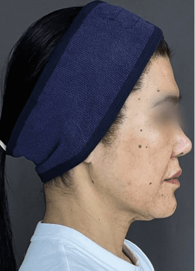 Antes - Perfilamento Facial