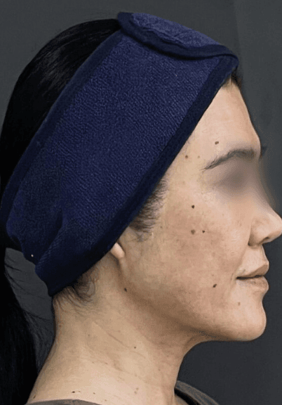 Depois - Perfilamento Facial