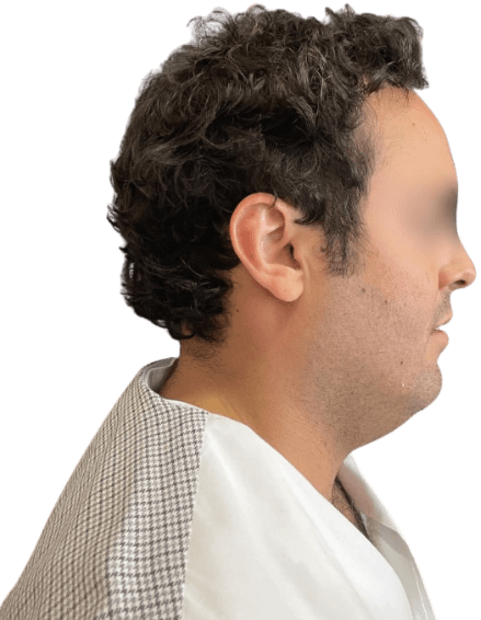 Antes - Queixo Duplo (Papada)